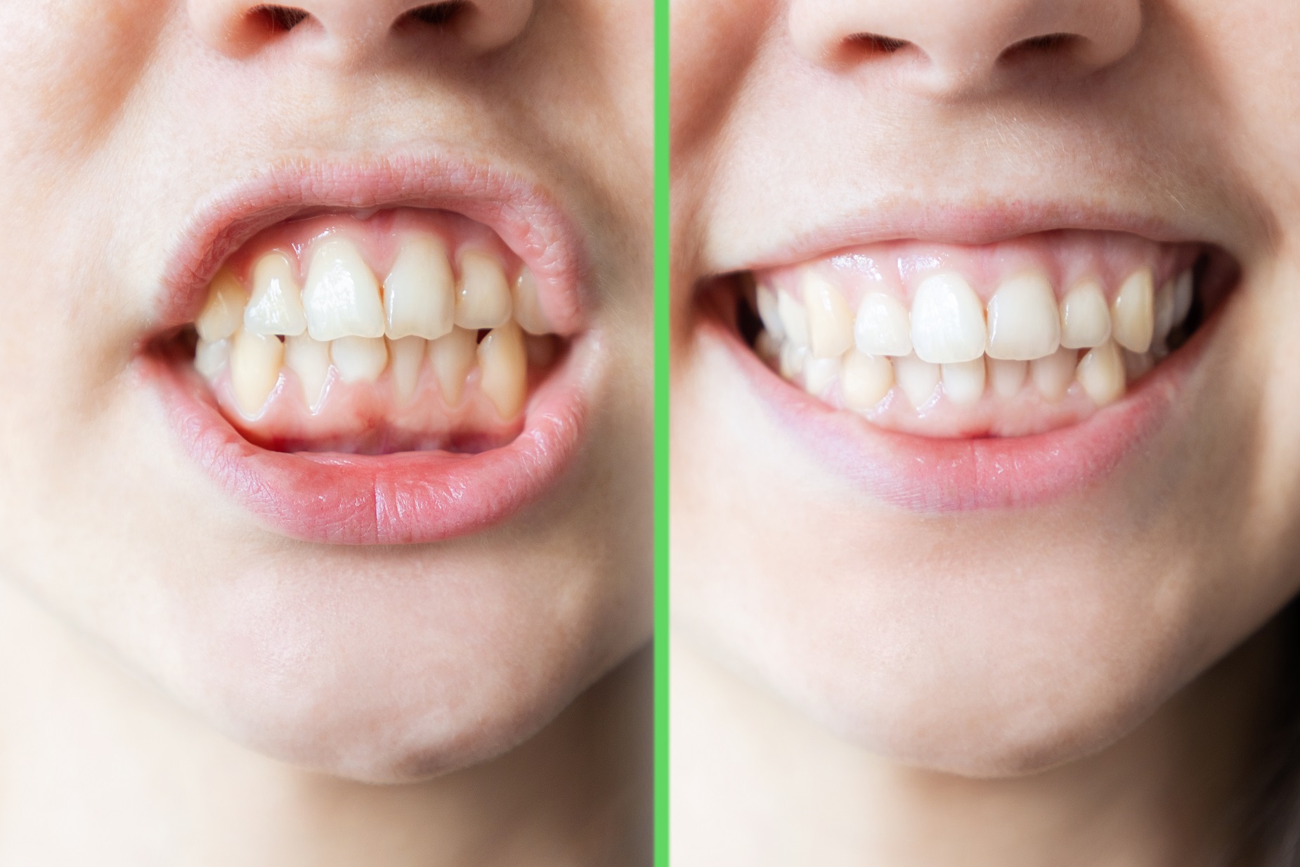 Invisalign